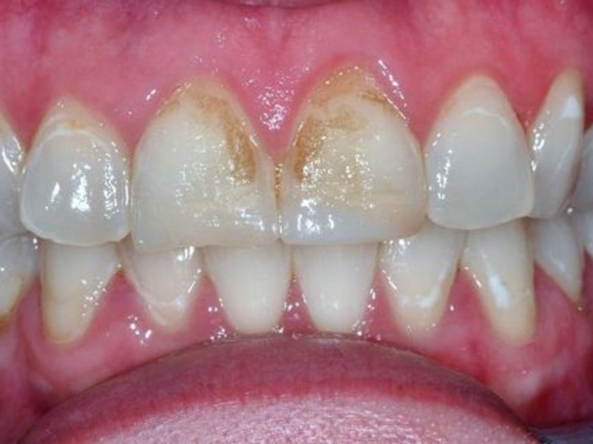 Dental Crowns: Case 20 — before