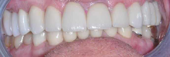 Dental Crowns: Case 25 — after