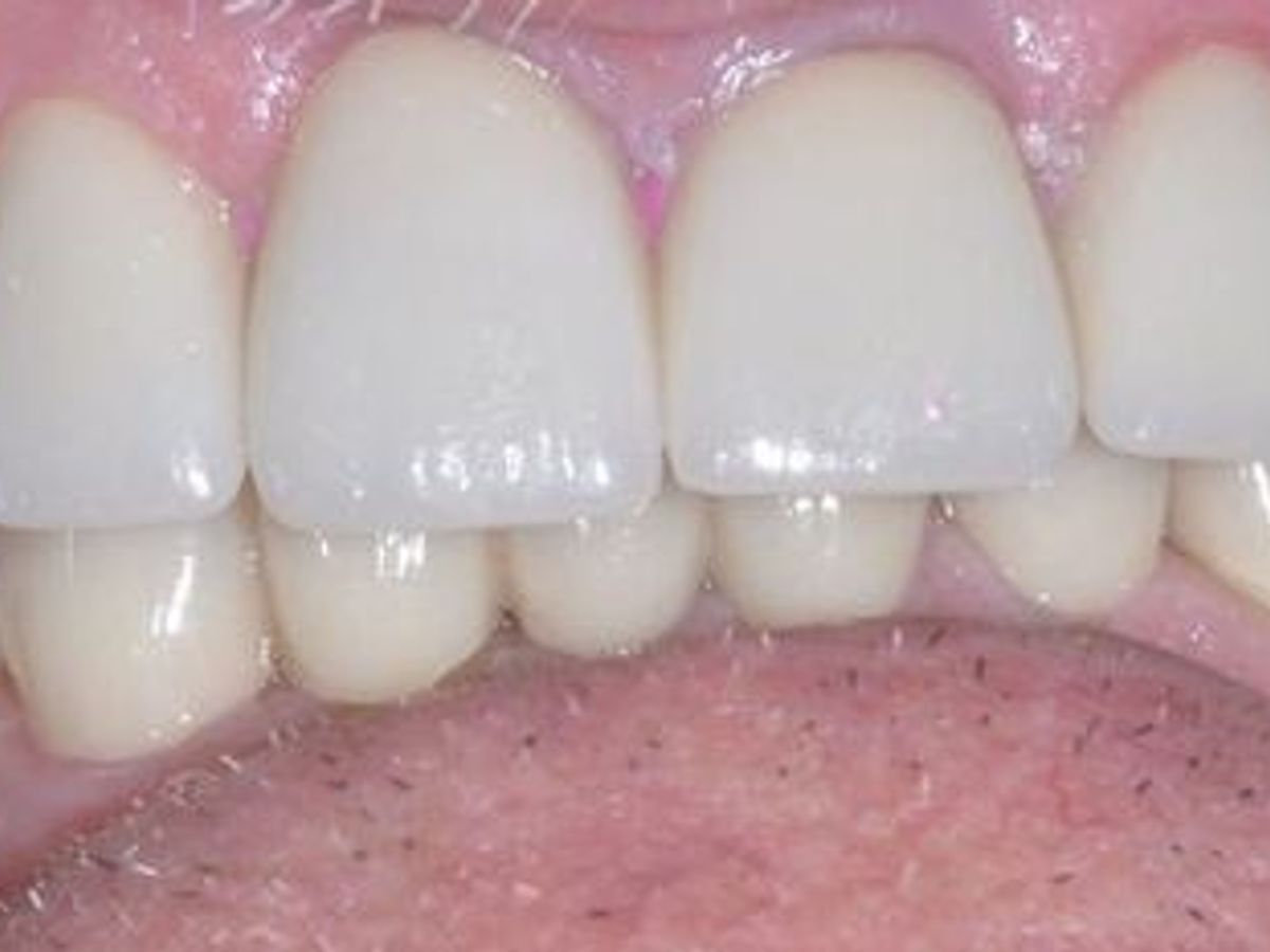 Dental Crowns: Case 25 — after