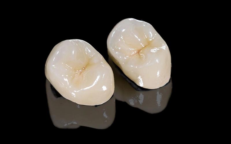 What Are the Benefits of Same-Day Crowns?