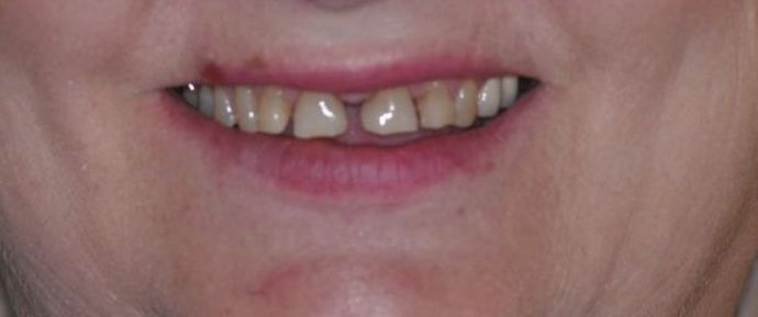 Dental Crowns: Case 14 — before