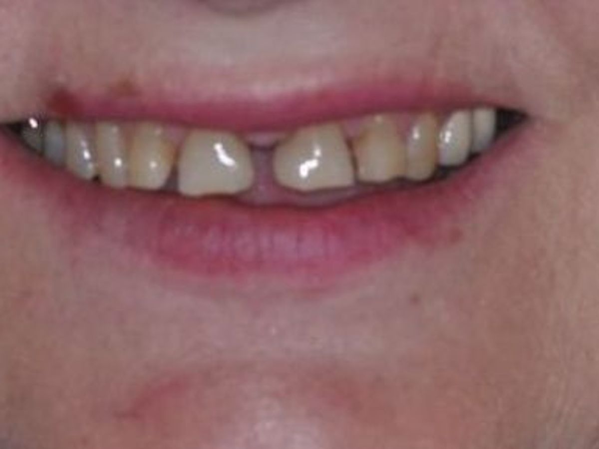 Dental Crowns: Case 14 — before