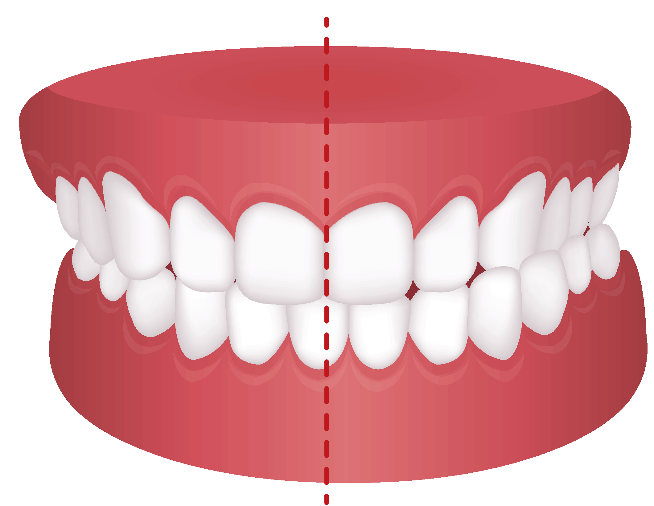 crossbite diagram