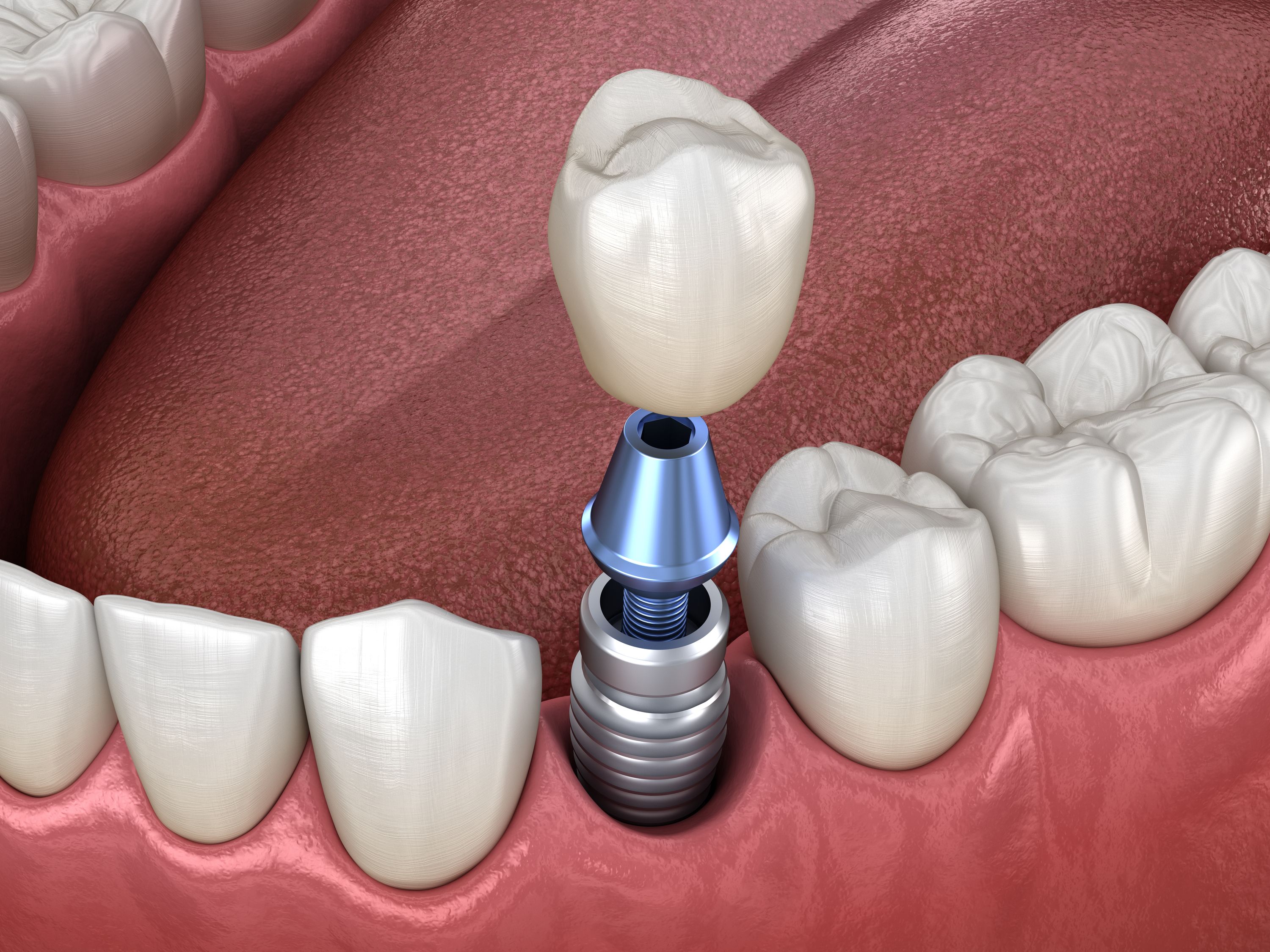 How Long Will My Dental Implant Surgery Recovery Take?