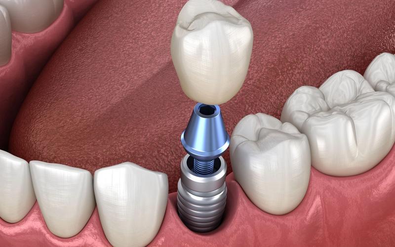 How Long Will My Dental Implant Surgery Recovery Take?