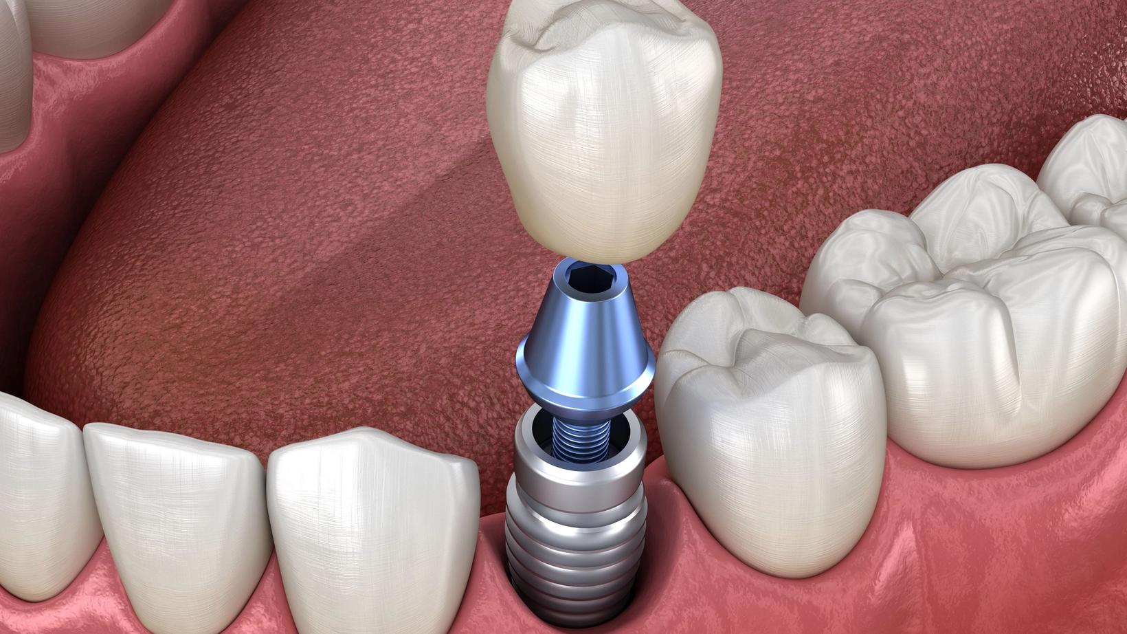 How Long Will My Dental Implant Surgery Recovery Take?