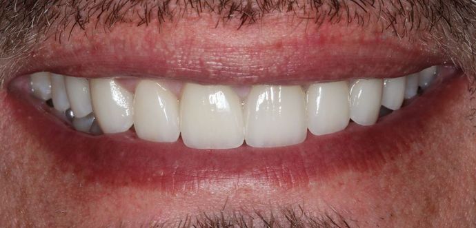 Veneers: Case 4 — after