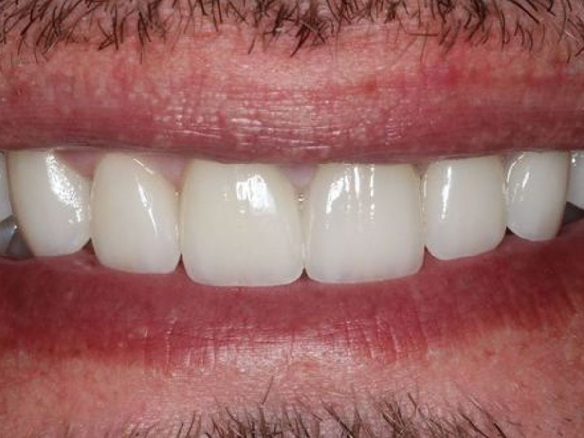 Veneers: Case 4 — after