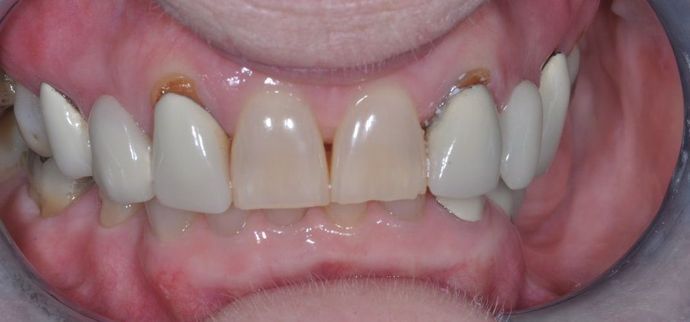 Dental Crowns: Case 19 — before