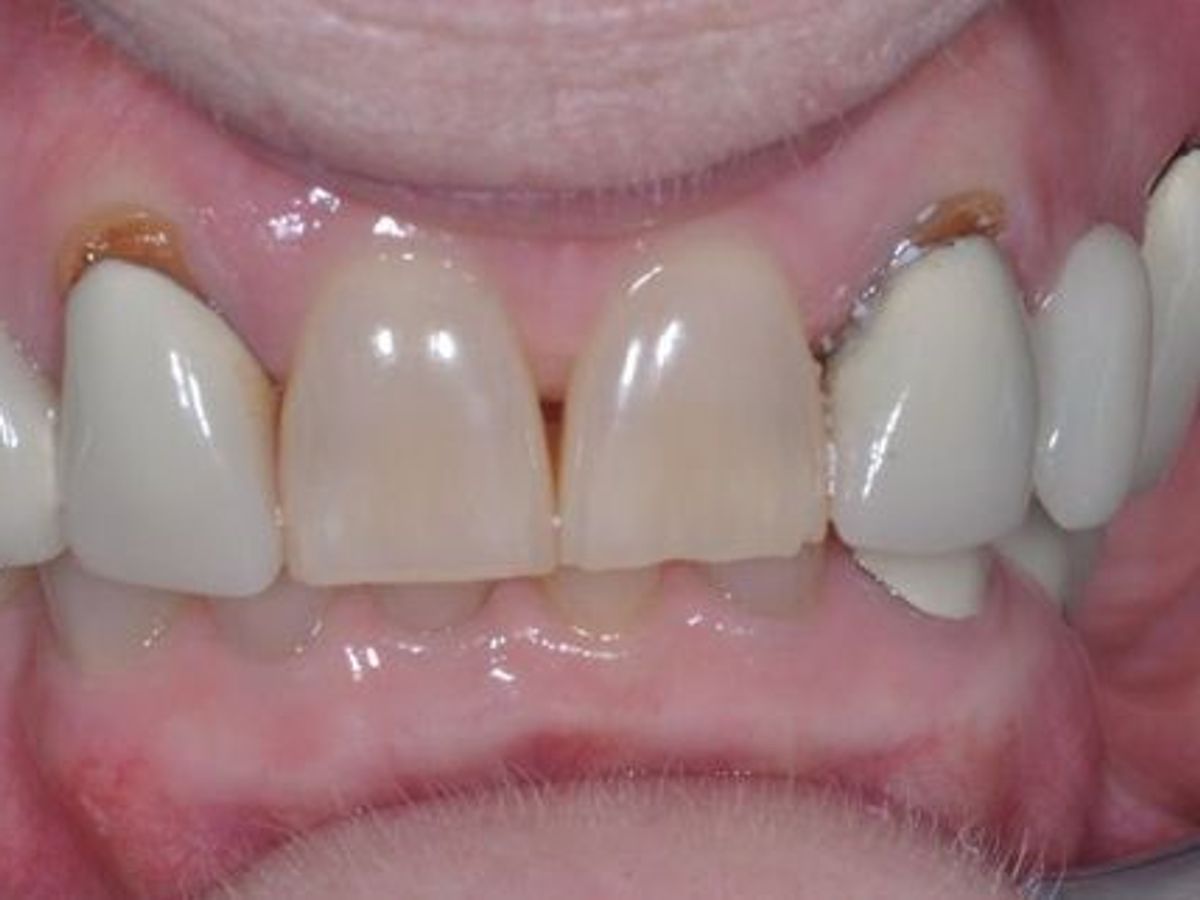 Dental Crowns: Case 19 — before