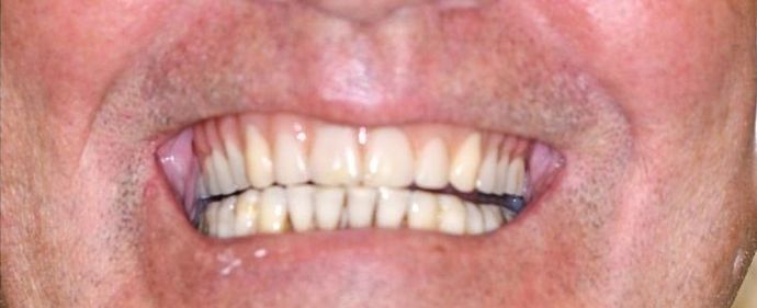 Teeth in a Day: Case 14 — Upper Arch / Restoration before