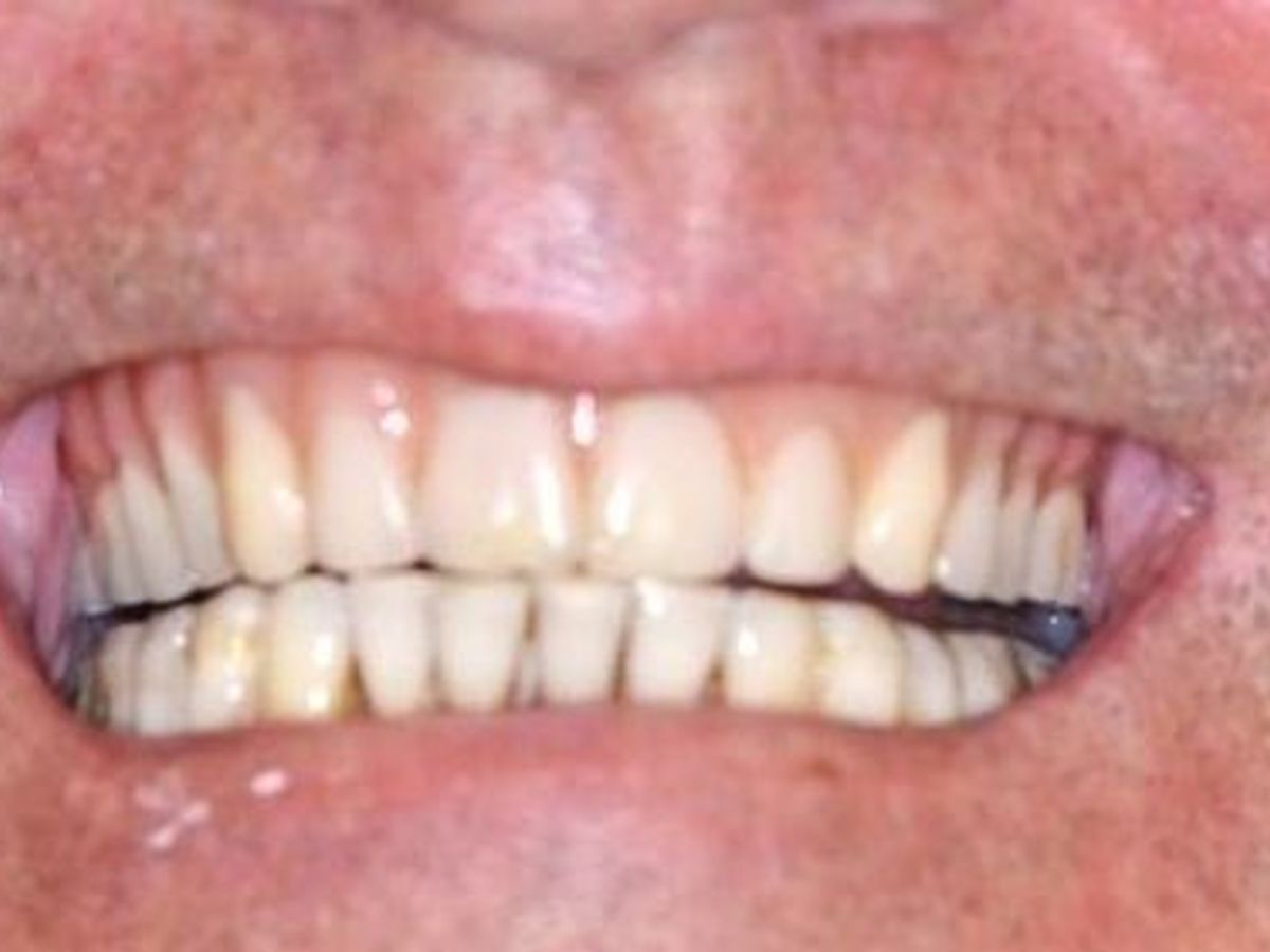 Teeth in a Day: Case 14 — Upper Arch / Restoration before