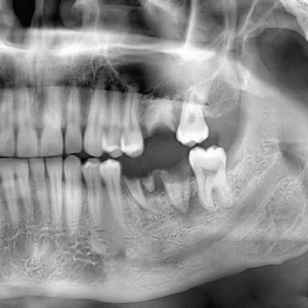 Filling Those Gaps: Treatment Options for Missing Teeth