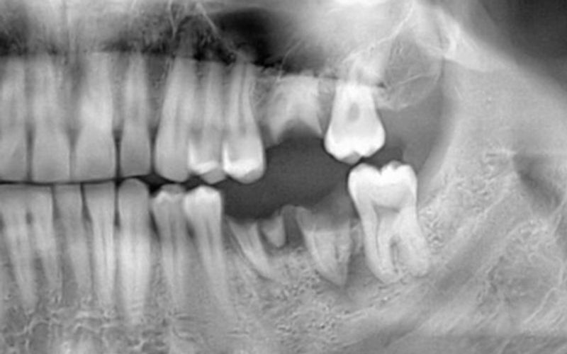 Filling Those Gaps: Treatment Options for Missing Teeth