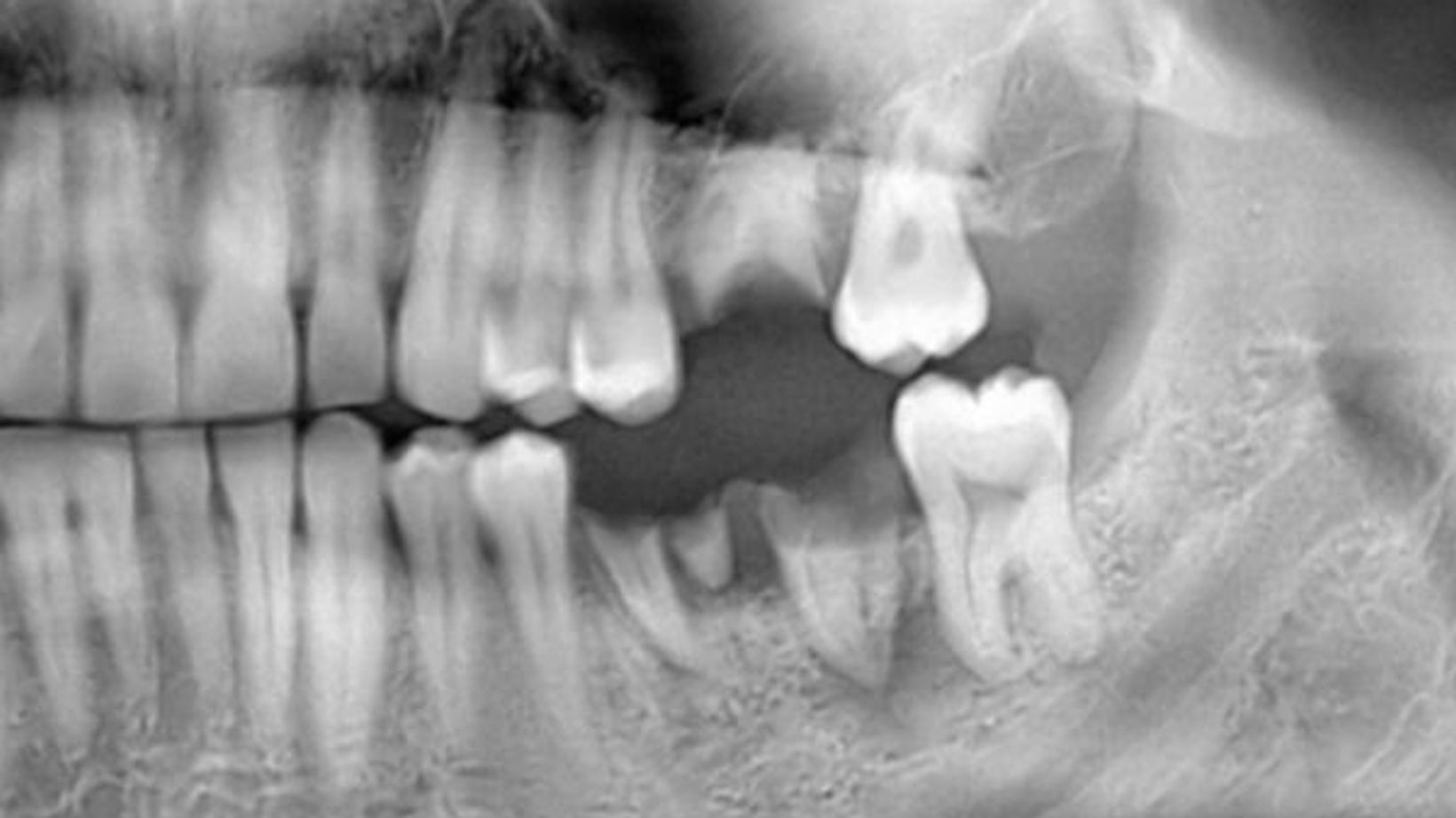 Filling Those Gaps: Treatment Options for Missing Teeth