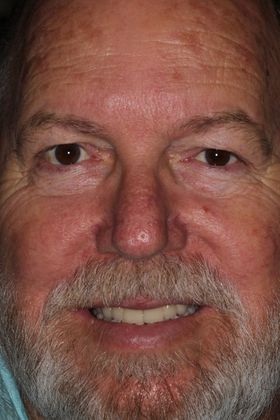 Dental Implants: Case 8 — after