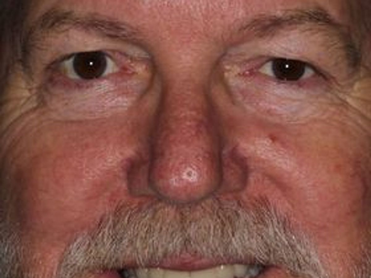 Dental Implants: Case 8 — after