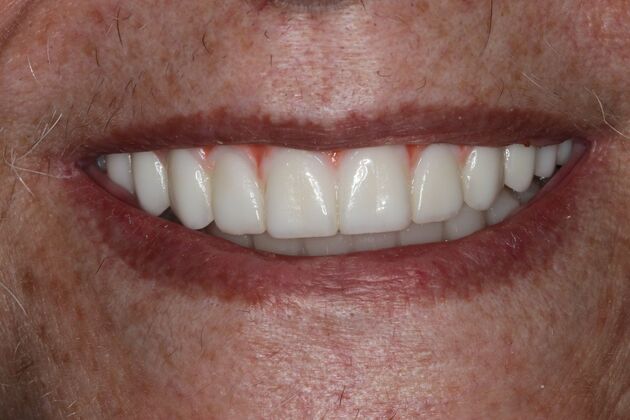Teeth in a Day: Case 30 — after