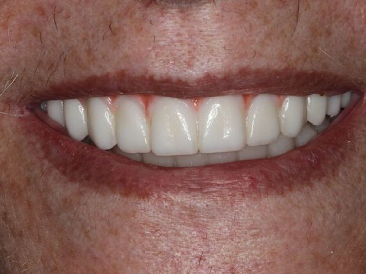 Teeth in a Day: Case 30 — after