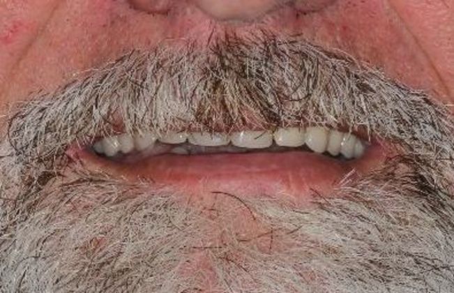 Dentures: Case 5 — before