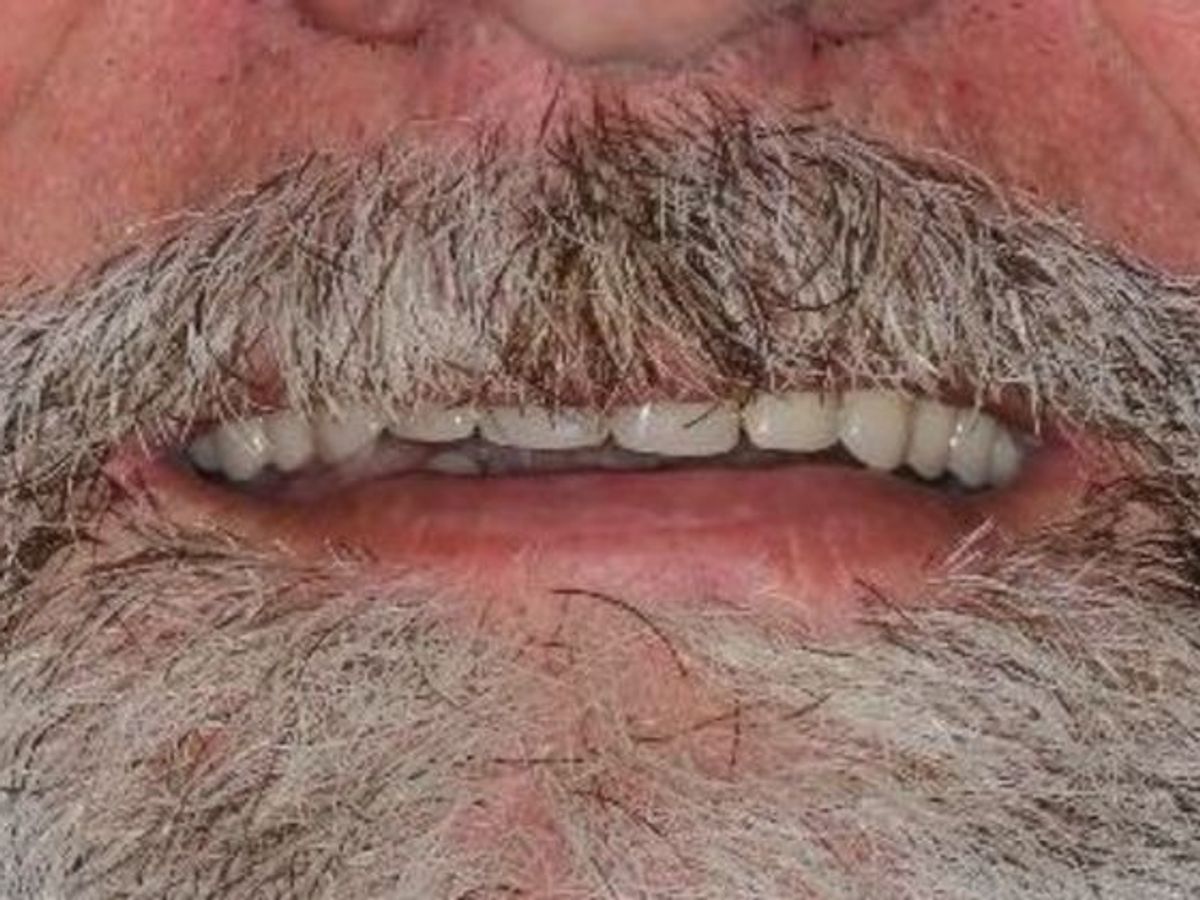 Dentures: Case 5 — before