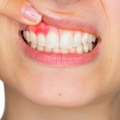 Person with receding gum-line