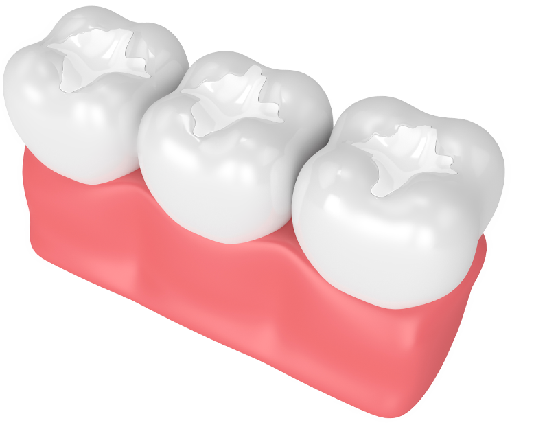 Dental Bridge Aftercare: Having a Healthy Smile