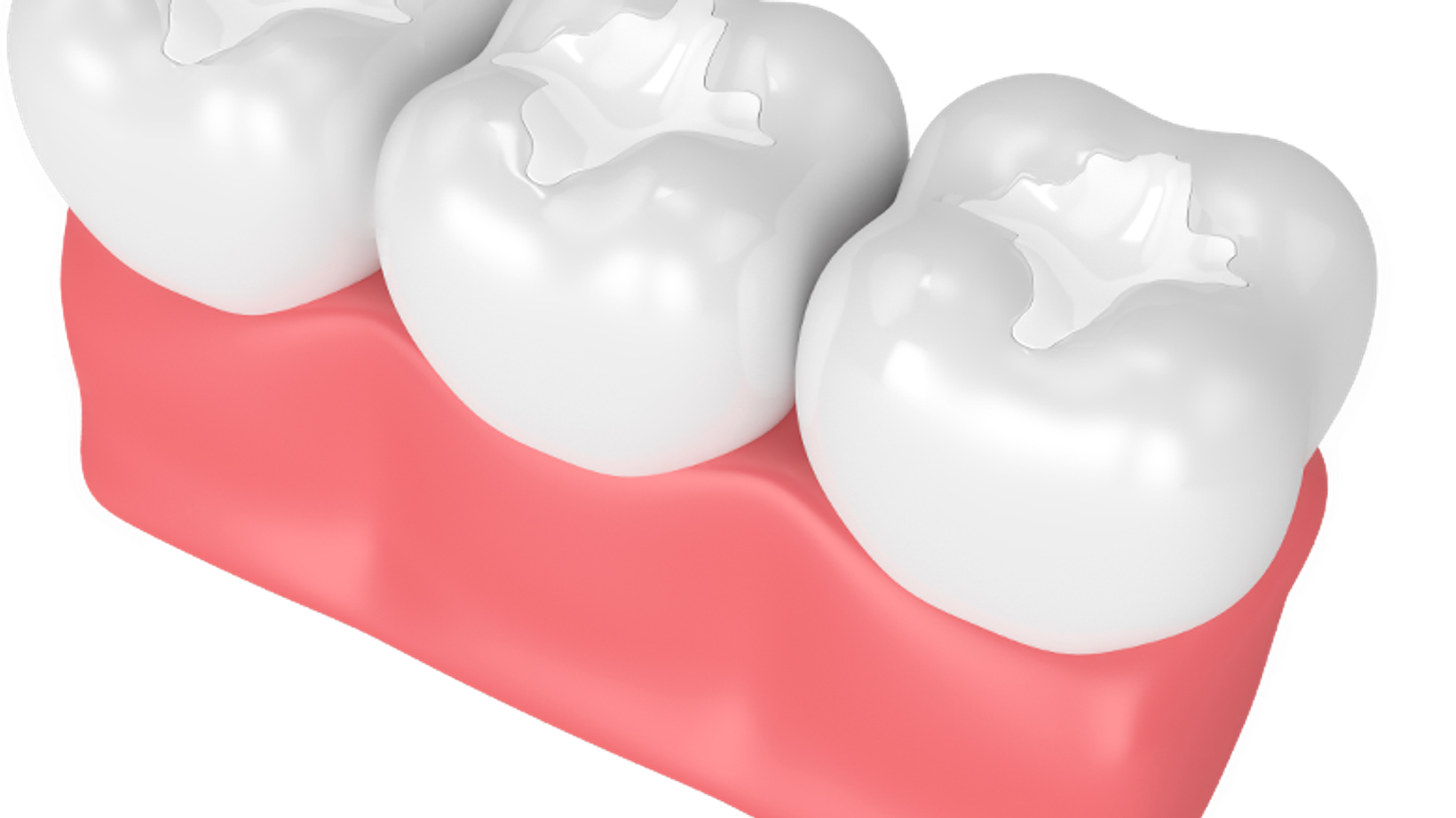 Dental Bridge Aftercare: Having a Healthy Smile