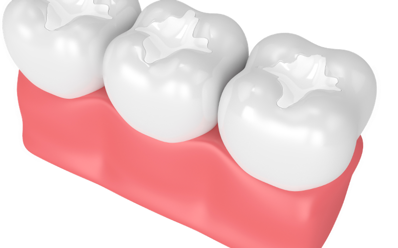 Dental Bridge Aftercare: Having a Healthy Smile