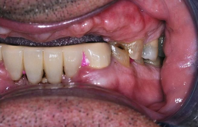 Dental Implants: Case 3 — before