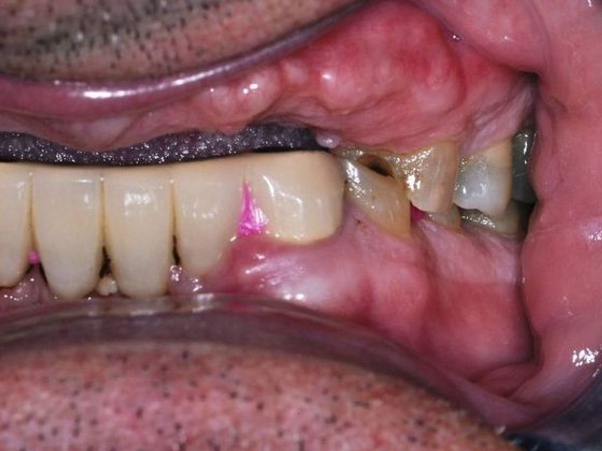 Dental Implants: Case 3 — before