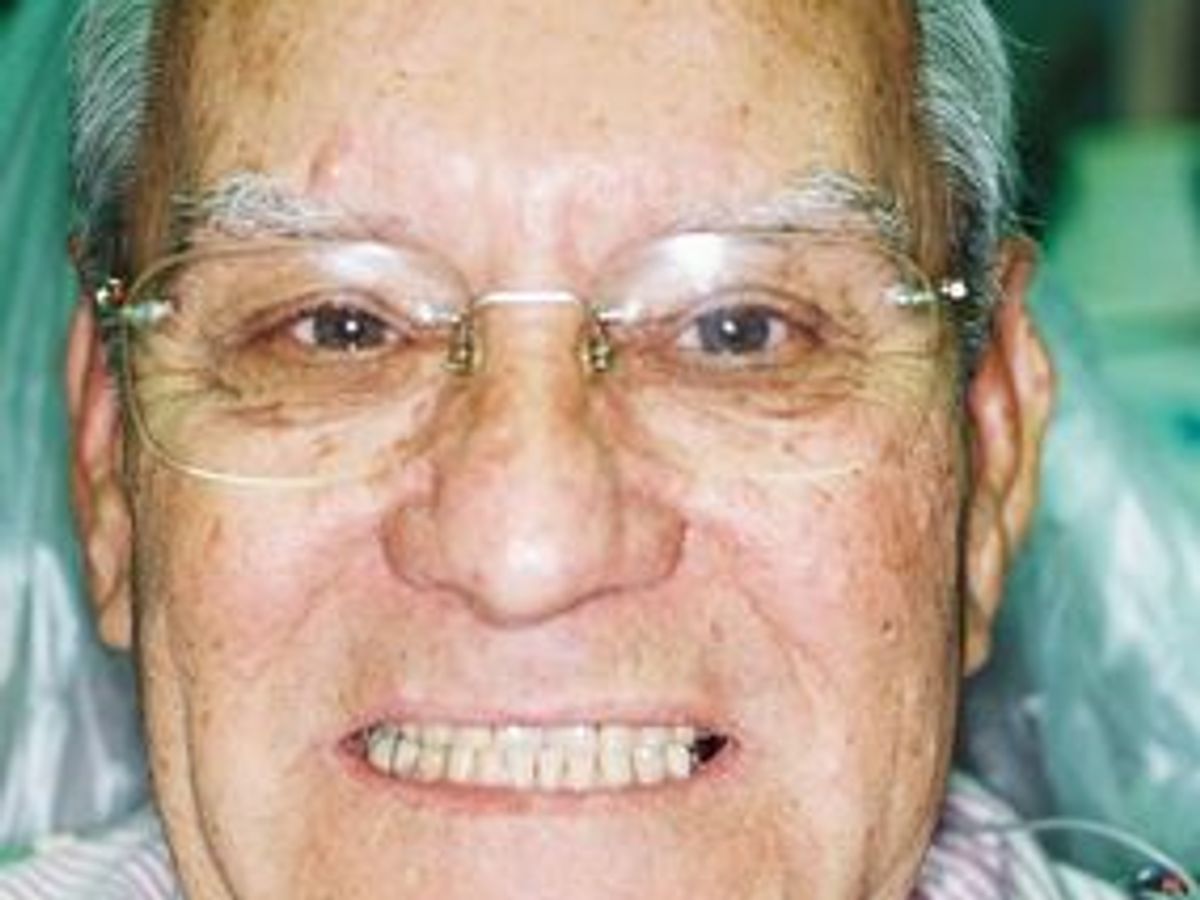Dental Crowns: Case 1 — before