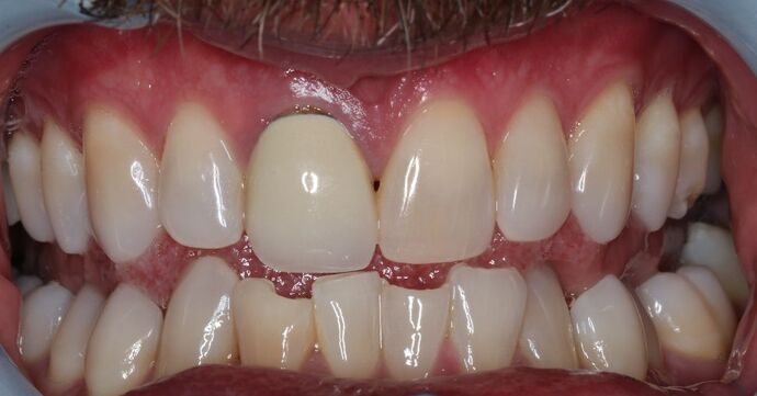 Veneers: Case 24 — After Lower Veneers before