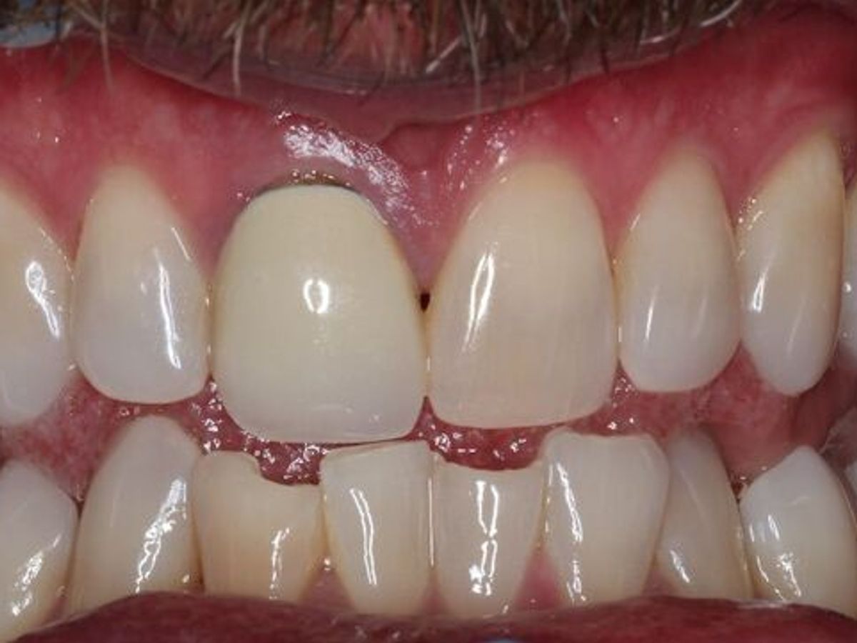 Veneers: Case 24 — After Lower Veneers before