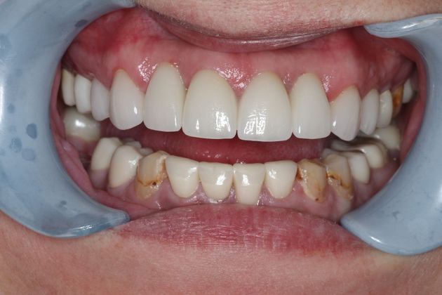 Patient's smile after dental implant treatment at Bell Dental