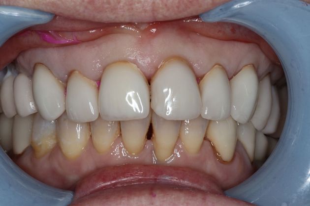 Veneers: Case 7 — before