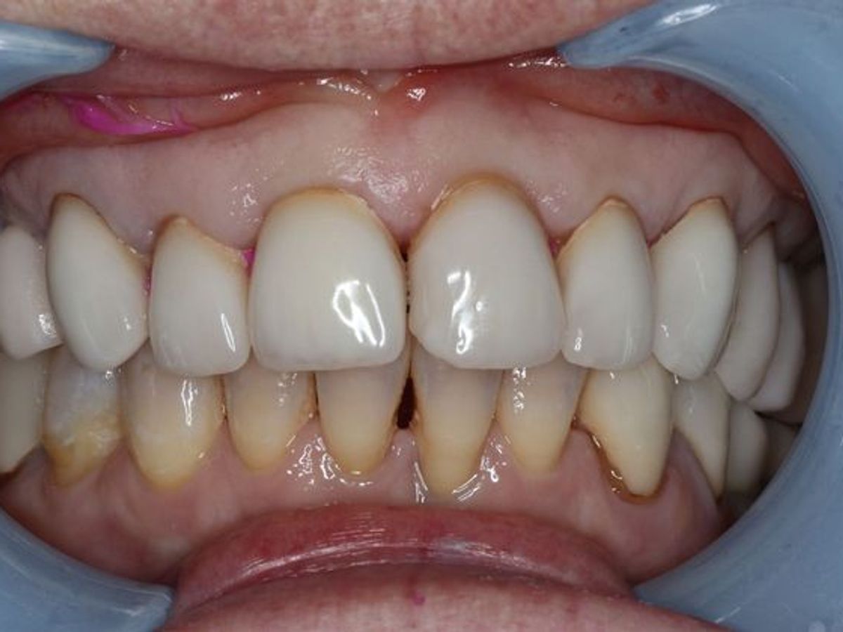 Veneers: Case 7 — before