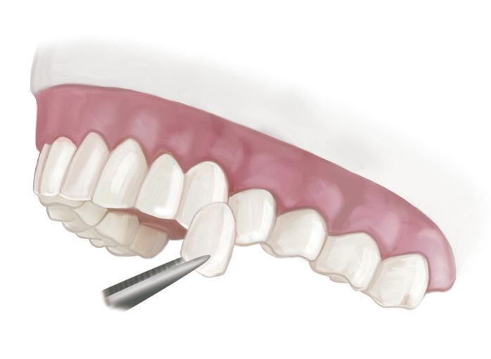 Porcelain Veneers Replacement Treatment