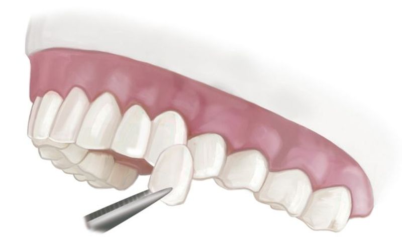Porcelain Veneers Replacement Treatment