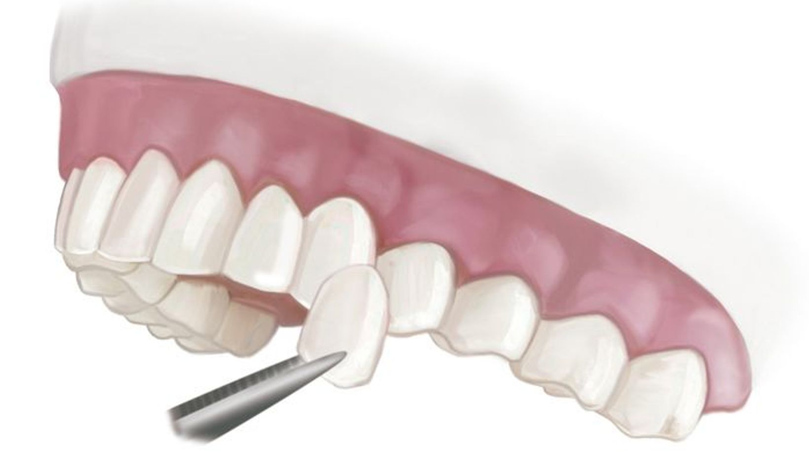 Porcelain Veneers Replacement Treatment