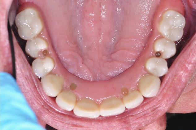Teeth in a Day: Case 9 — Upper and Lower Arch / Upper Arch after