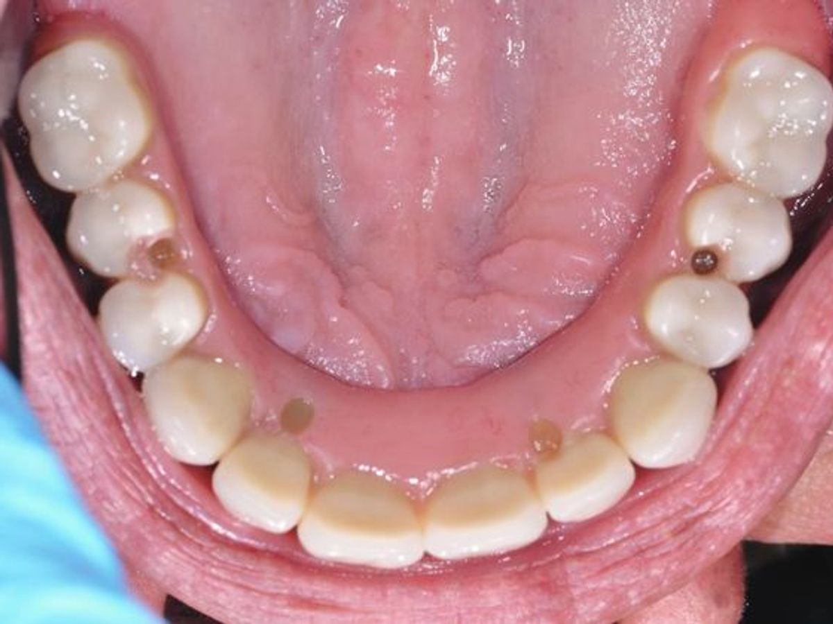 Teeth in a Day: Case 9 — Upper and Lower Arch / Upper Arch after