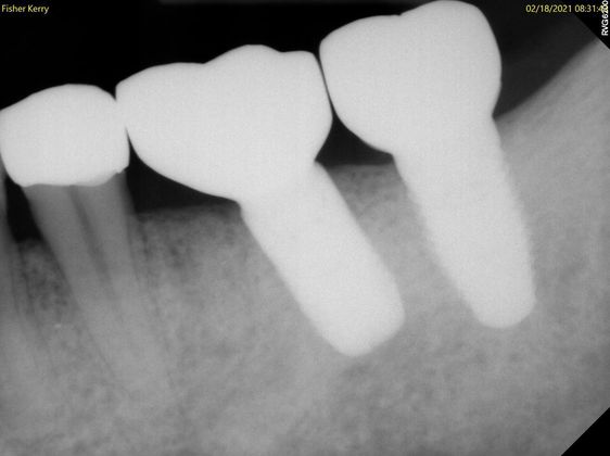 Dental Implants: Case 9 — after
