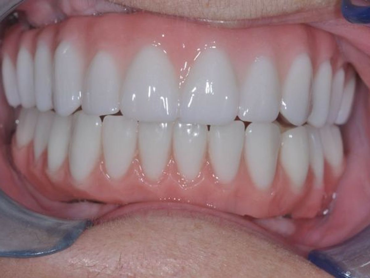 Teeth in a Day: Case 8 — after