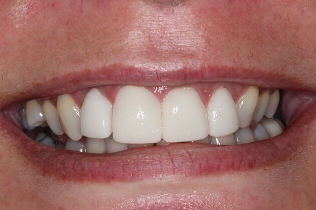 Veneers: Case 29 — before