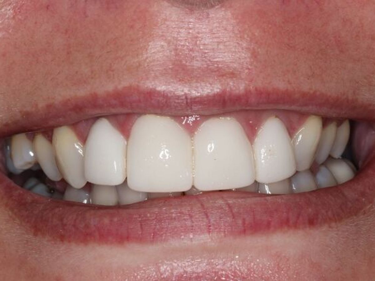 Veneers: Case 29 — before