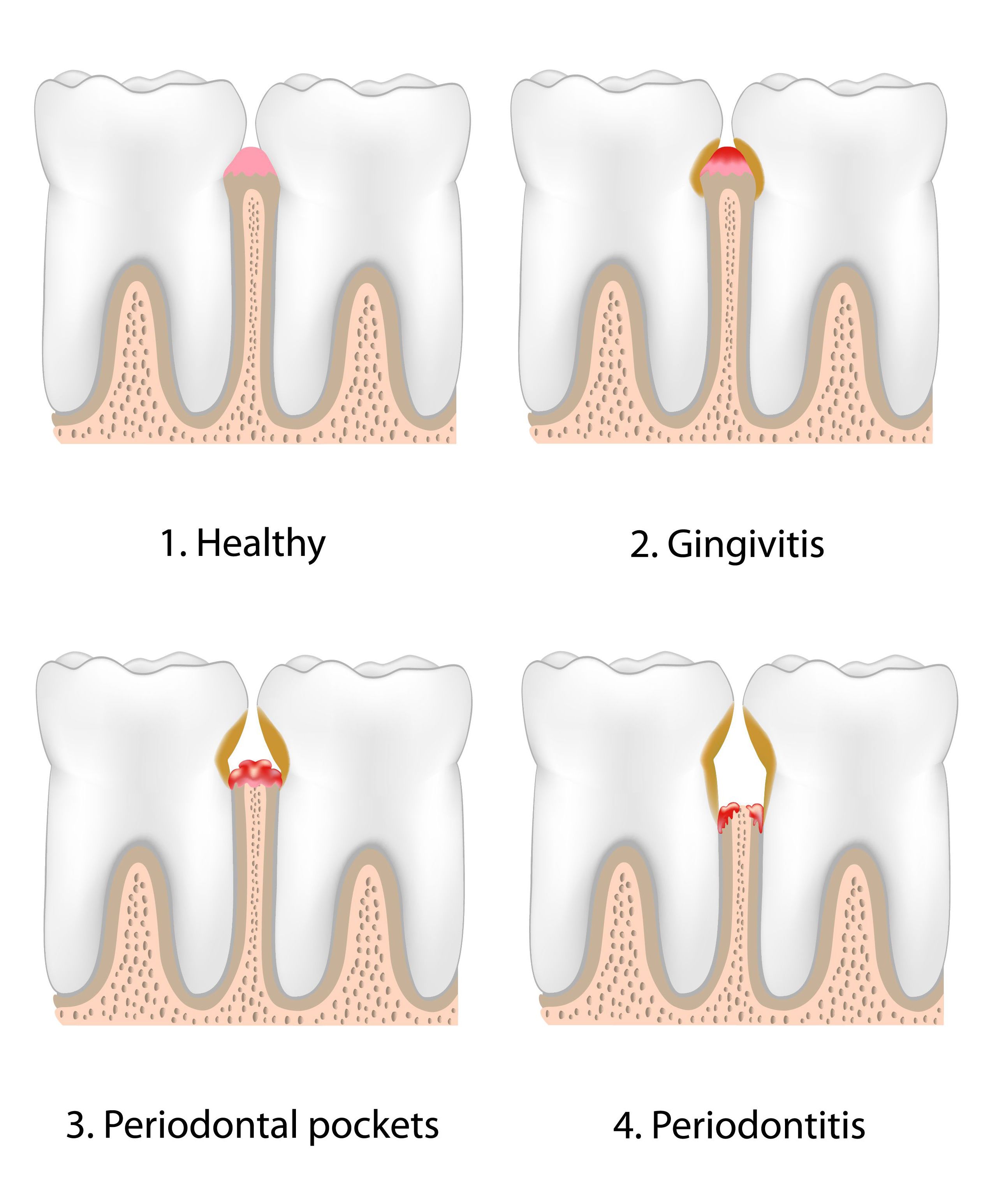 The Stages of Gum Disease