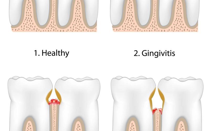 The Stages of Gum Disease