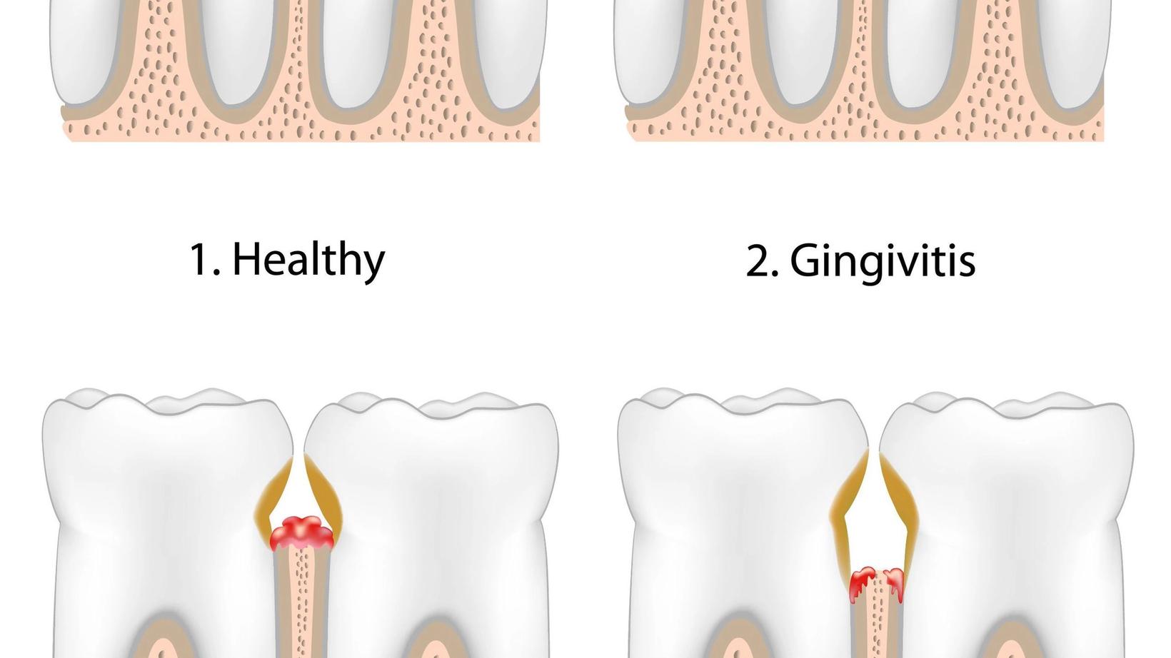 The Stages of Gum Disease