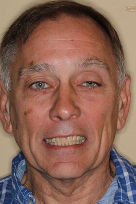 Veneers: Case 31 — before
